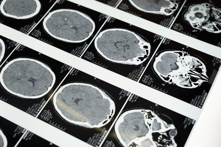 Blood test can detect dementia in women 25 years before symptoms begin