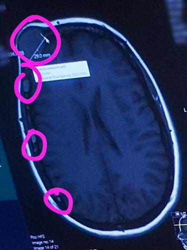 “I thought my lump was a cyst, but it was actually deadly cancer eating my skull”