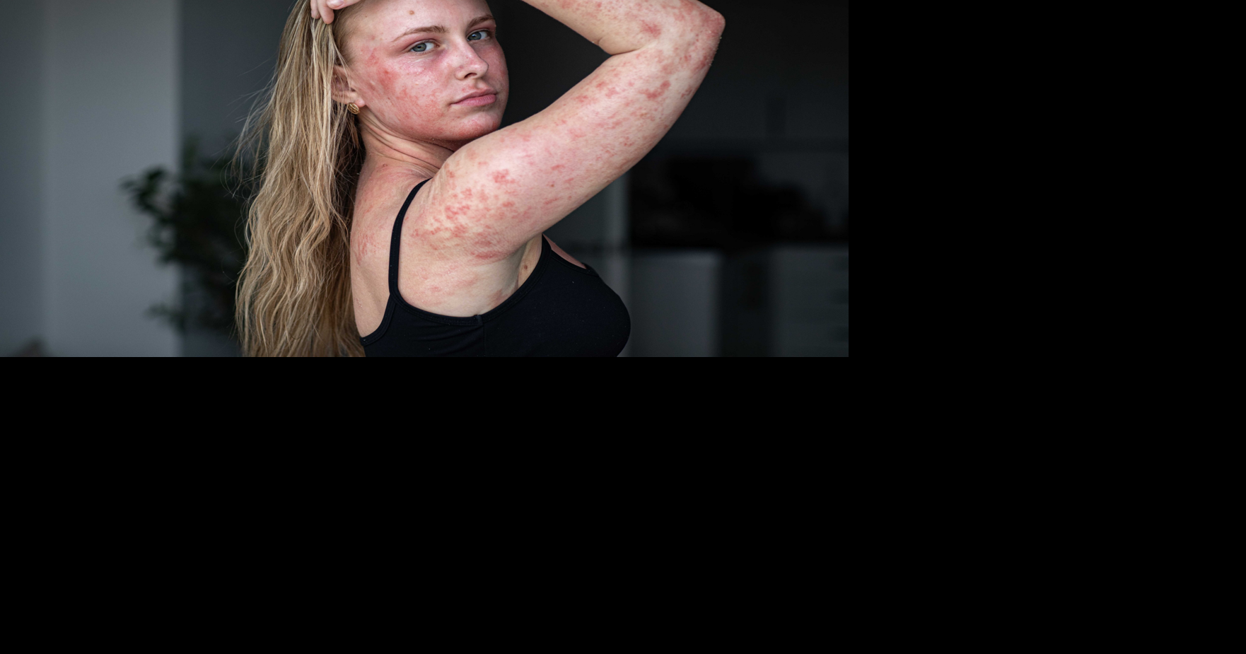 Woman left in agony after eczema cream leaves 95% of skin in pain