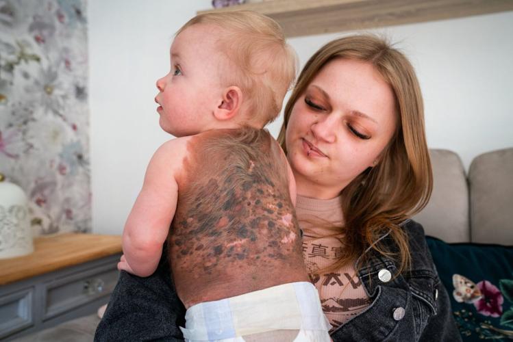 Family’s plea as baby’s ultra-rare birthmark tests as cancerous