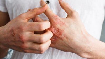 Dry, Cracked Hands That Won’t Go Away? 5 Things to Know About Chronic Hand Eczema