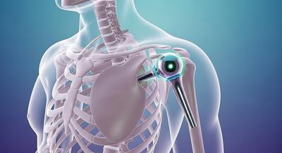 Obesity No Barrier For Shoulder Replacement Surgery, Study Finds