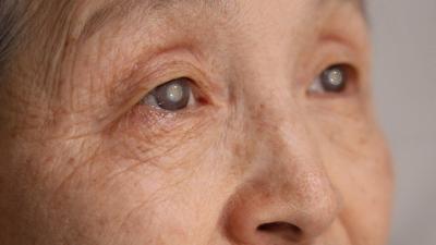 Are you about to have cataract surgery? Here’s what ophthalmologists say you need to know