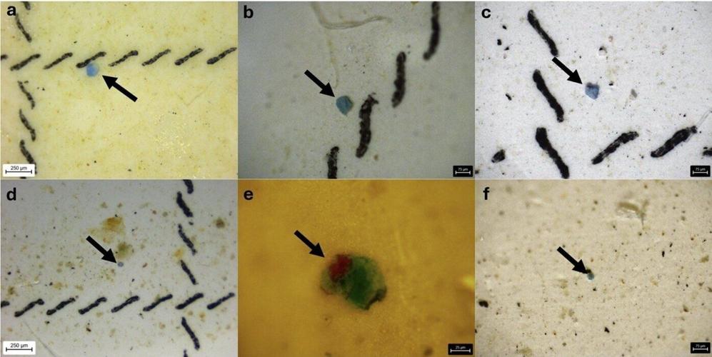 People diagnosed with lung cancer have more microplastic in their lungs