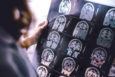 Diabetes Drugs Might Counter Brain Decline In Early Alzheimer's Patients