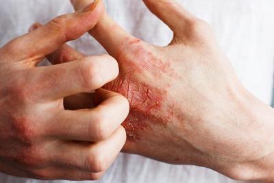 New AI Can Help Track Eczema