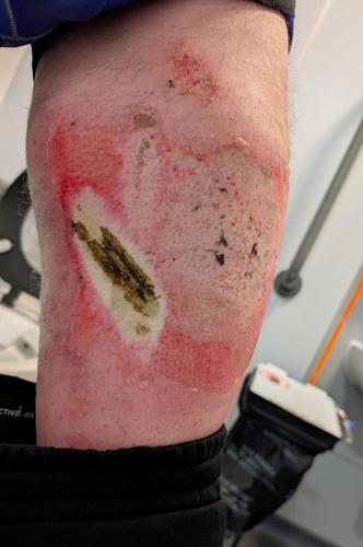 Man suffers serious burns to leg after vape battery explodes in his pocket