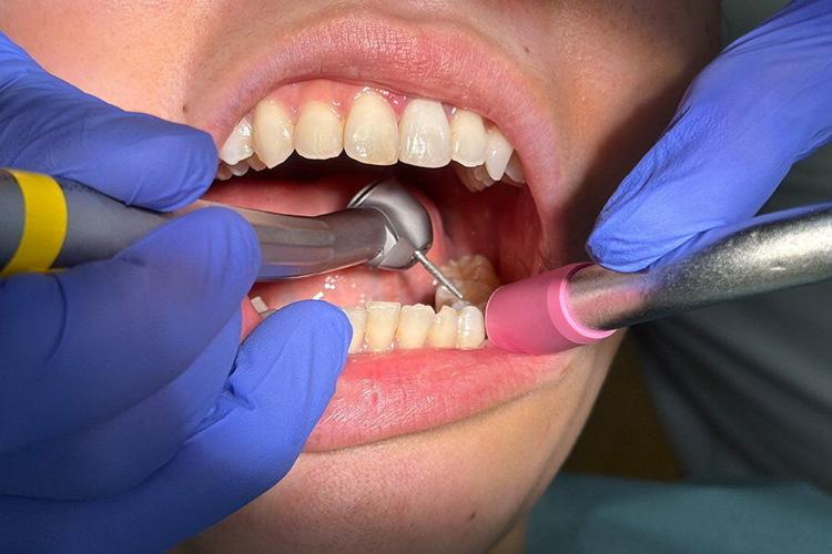 A dental drill being used in a patients mouth.