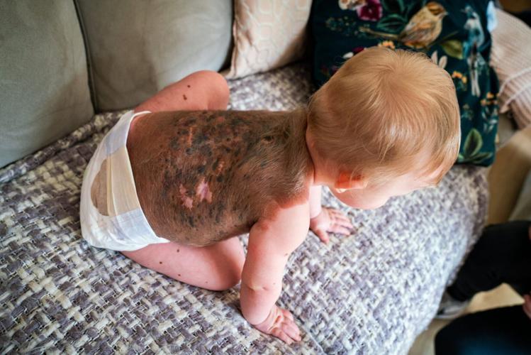 Family’s plea as baby’s ultra-rare birthmark tests as cancerous