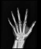 Korean 3D ‘glue gun’ prints custom bone repairs directly onto fractures