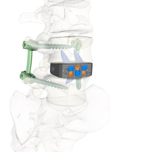 Zavation Medical Products Announces First Implantations of Varisync® ALIF NanoPrime™