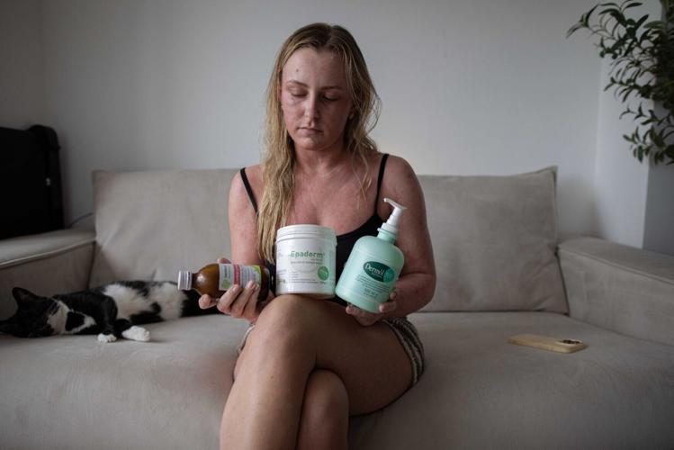 “My eczema cream left 95% of my body in agony – strangers think I’ve been burned”