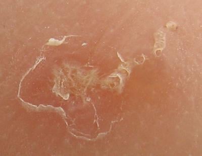 An Unwanted Winter Guest Scabies Food Living Lancaster Com Close Up Photo Of A Scabies Burrow The Large Scaly Patch Is From Scratching Mite Traveled Toward Upper Right And Can Be Seen At End
