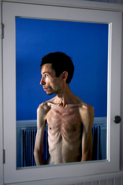 In the grip of anorexia and the medical industrial complex | Lifestyle ...