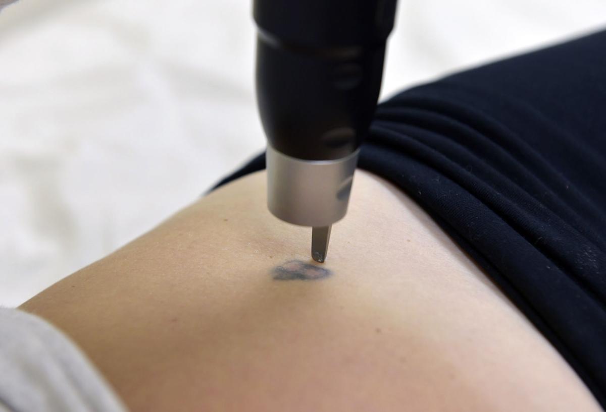 What you need to know about tattoo removal Trending