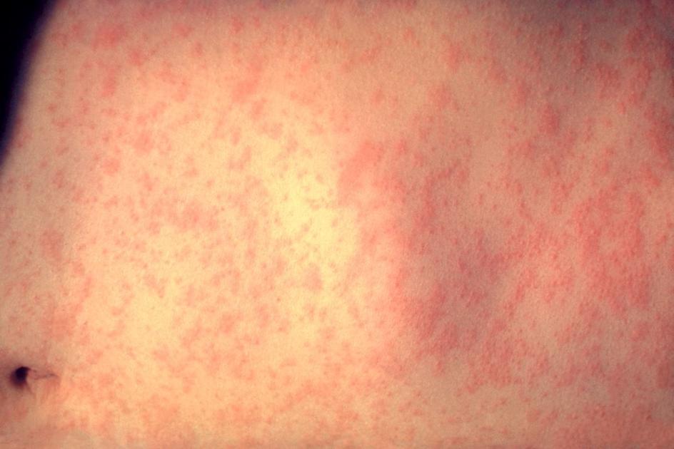 Measles has arrived in Lancaster County [update] | Local News - LancasterOnline thumbnail