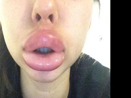 Kylie Jenner Challenge See Why Teens Are Paying The Price To Give Their Lips A Natural Pout Food Living Lancasteronline Com