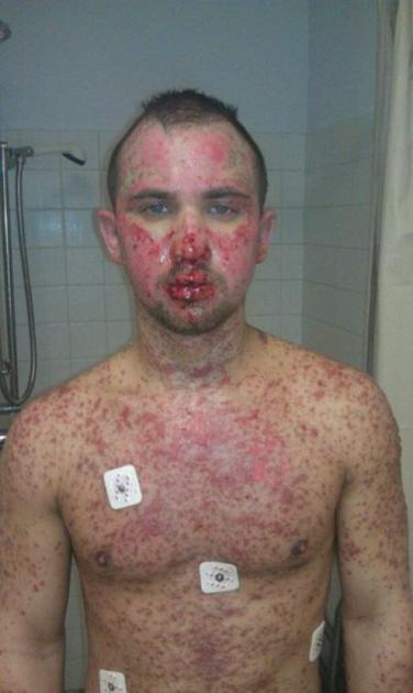 What is Stevens Johnson Syndrome? | Lifestyle | lancasteronline.com