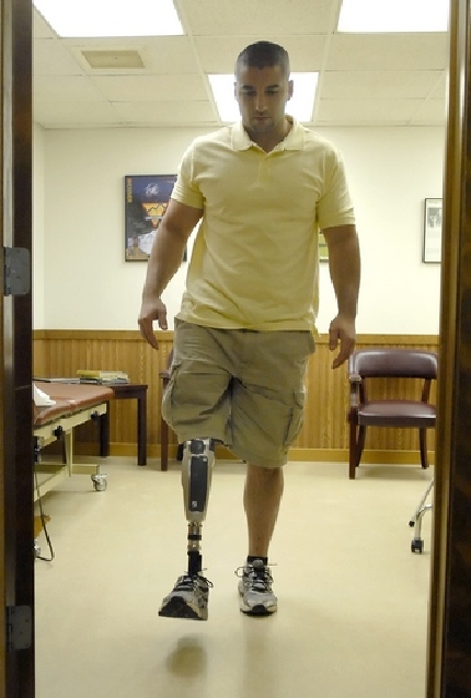 High Tech Artificial Limb Has Amputee On Move Once Again News Lancasteronline Com