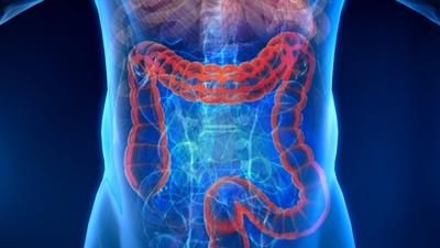 Colon cancer screening should start at 45