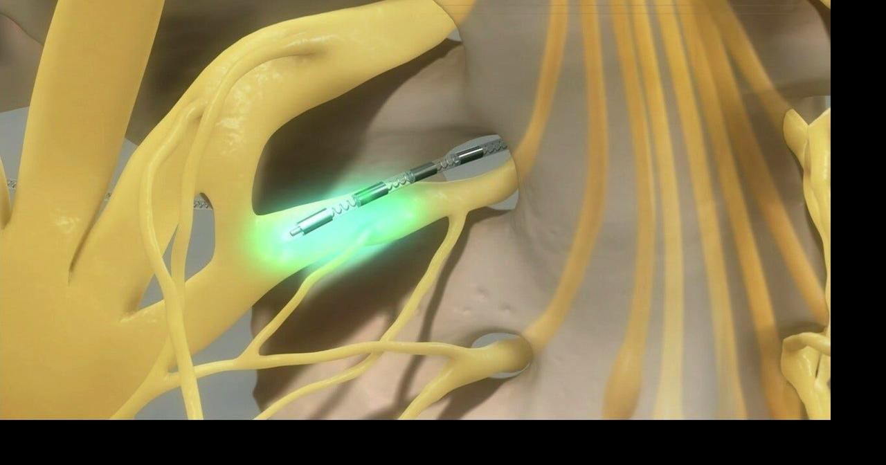 EYE ON HEALTH Procedure uses bladder 'pacemaker' device to help with