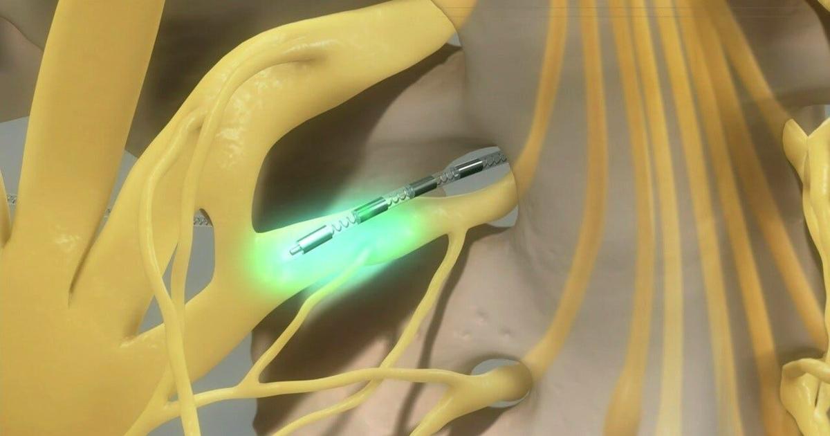 EYE ON HEALTH: Procedure uses bladder 'pacemaker' device to help with ...