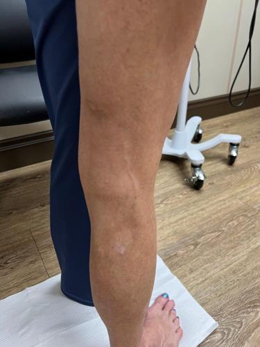 More Than Relief: How Vein Treatment at CVVS - Horizon Restored Stephanie’s Quality of Life