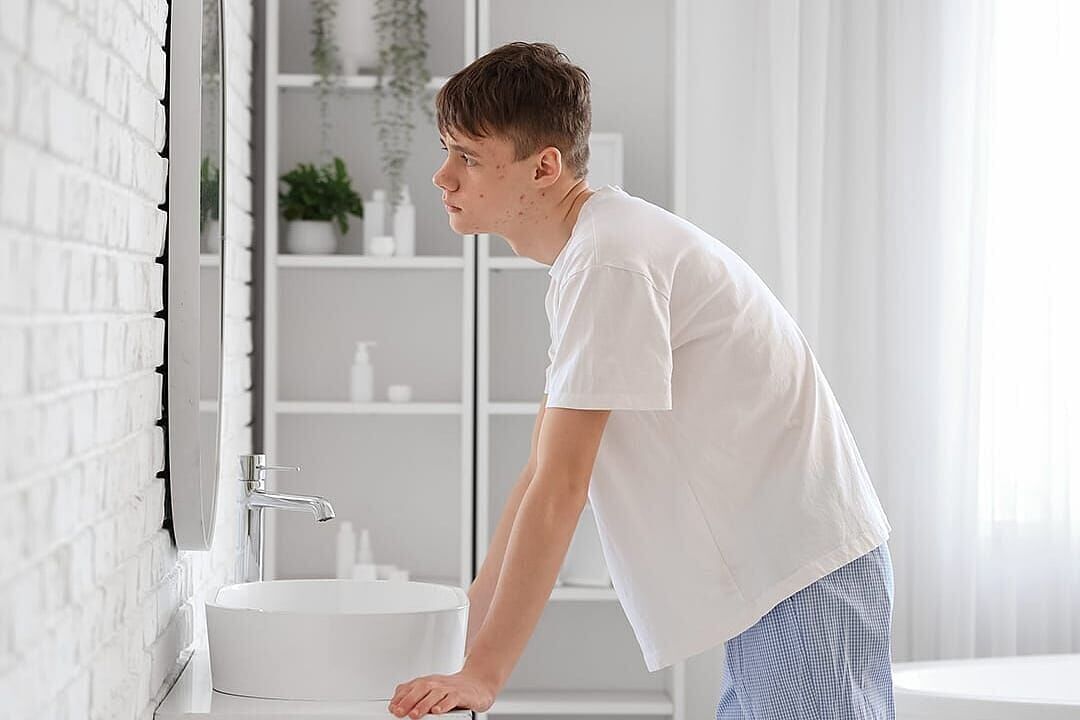 7 proven acne treatments for teens