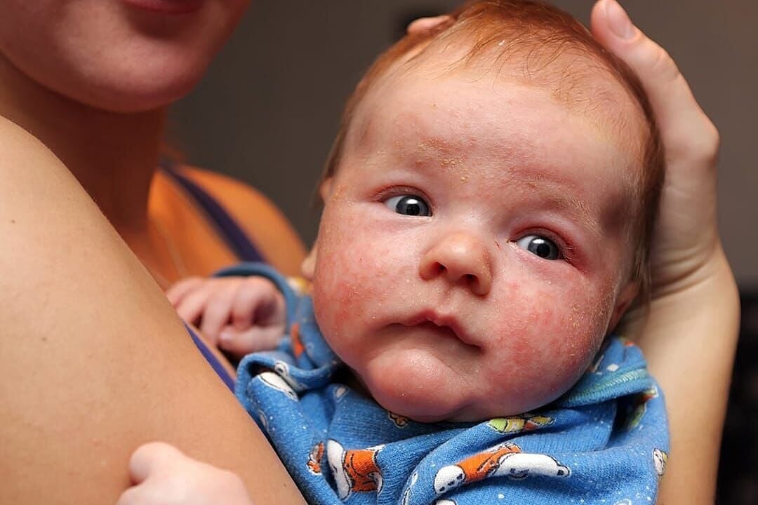 Eczema vs. psoriasis: How to tell these common skin conditions apart