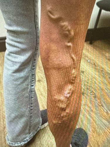 More Than Relief: How Vein Treatment at CVVS - Horizon Restored Stephanie’s Quality of Life