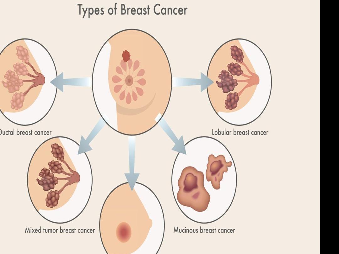 Types of Breast Cancer: Common Types, Other Types, Stats