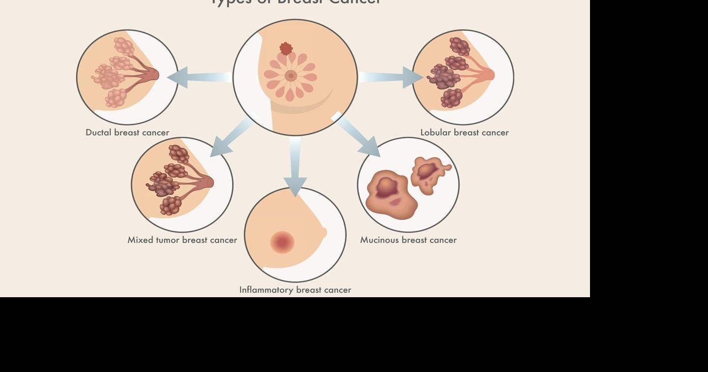 Inflammatory Breast Cancer: The Subtle Form of Breast Cancer