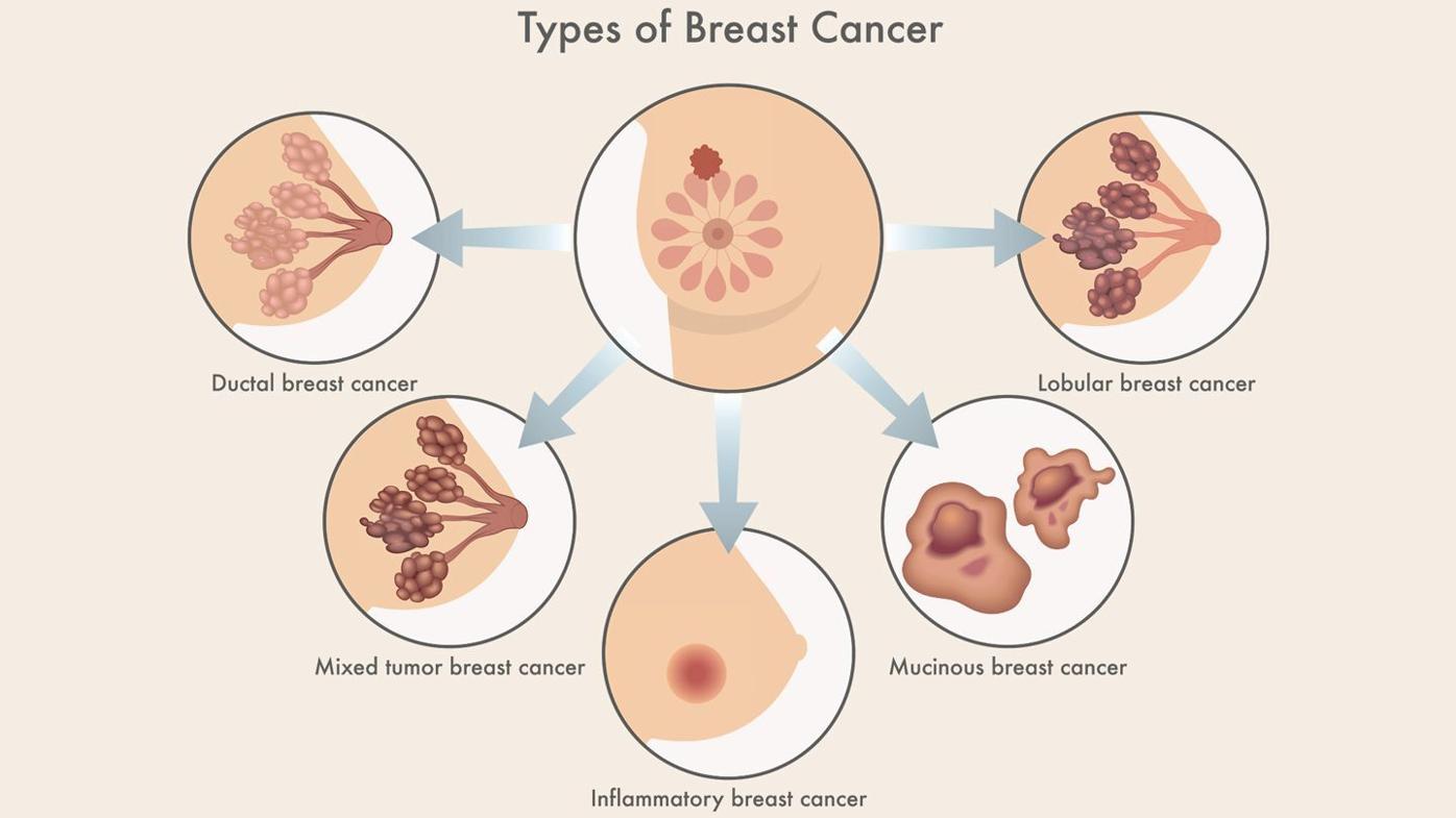 Breast cancer can manifest in many forms, Health Wellness