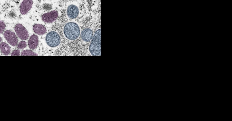 US cities could see summer mpox outbreak - Vimarsana News
