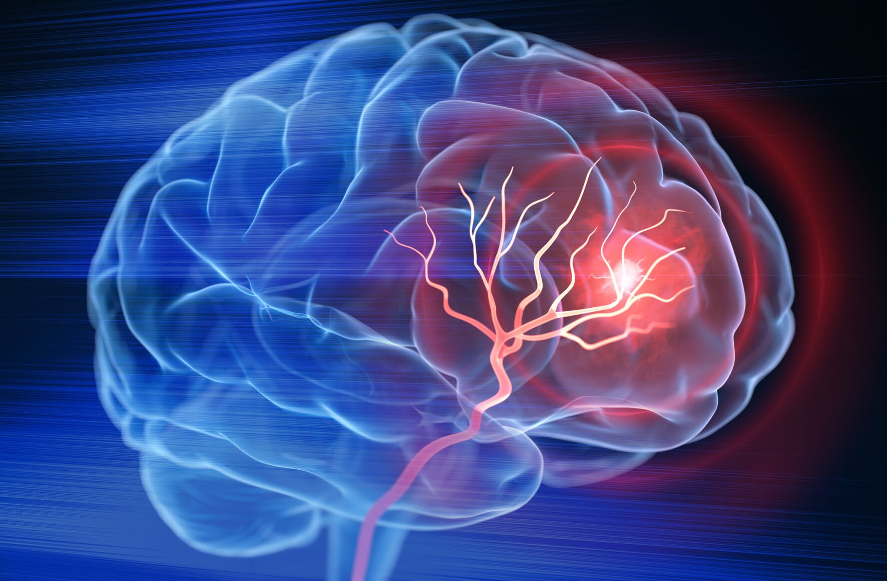 Brain stroke | | mkelifestyle.com