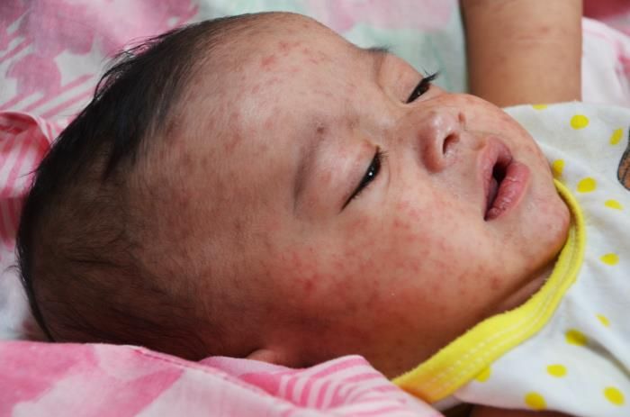 Measles