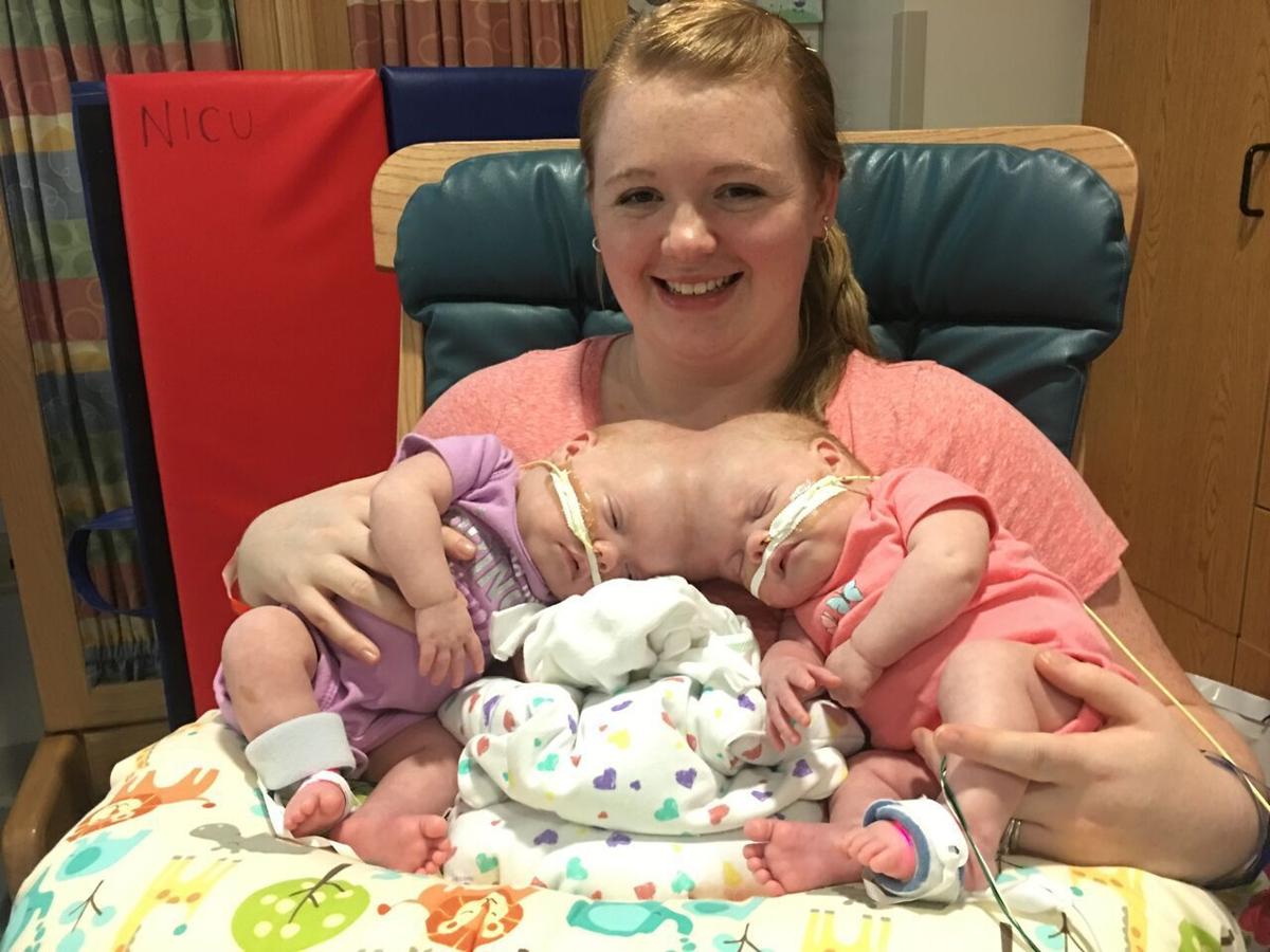 Conjoined Mooresville Twins Doing Well After Separation
