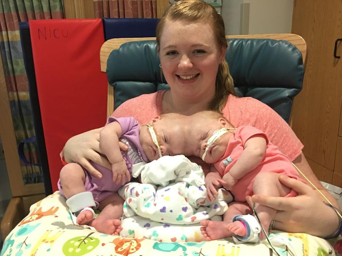 Conjoined Mooresville twins doing well after separation News