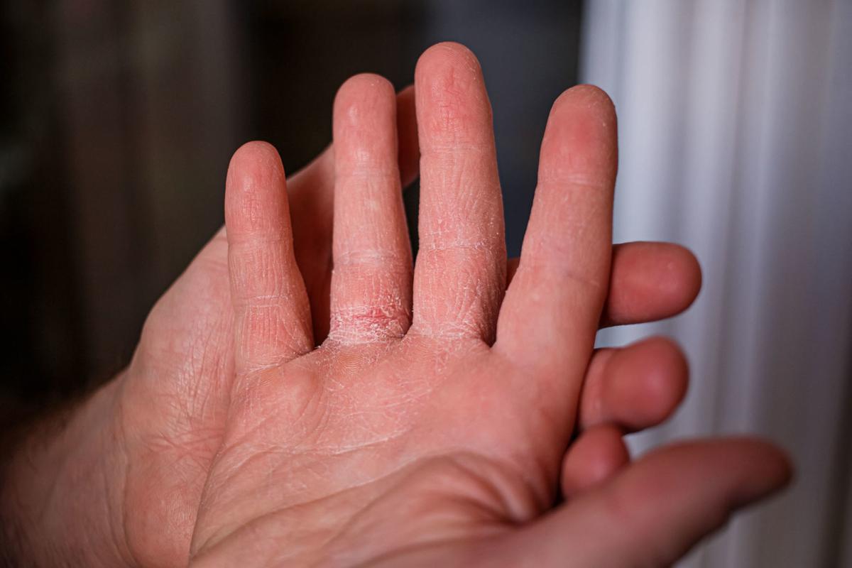 DRY SKIN