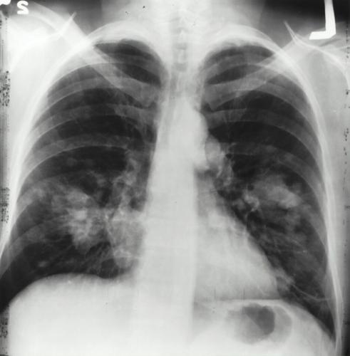 Sudden surge in lung cancer cases in non-smokers may be due to this ...