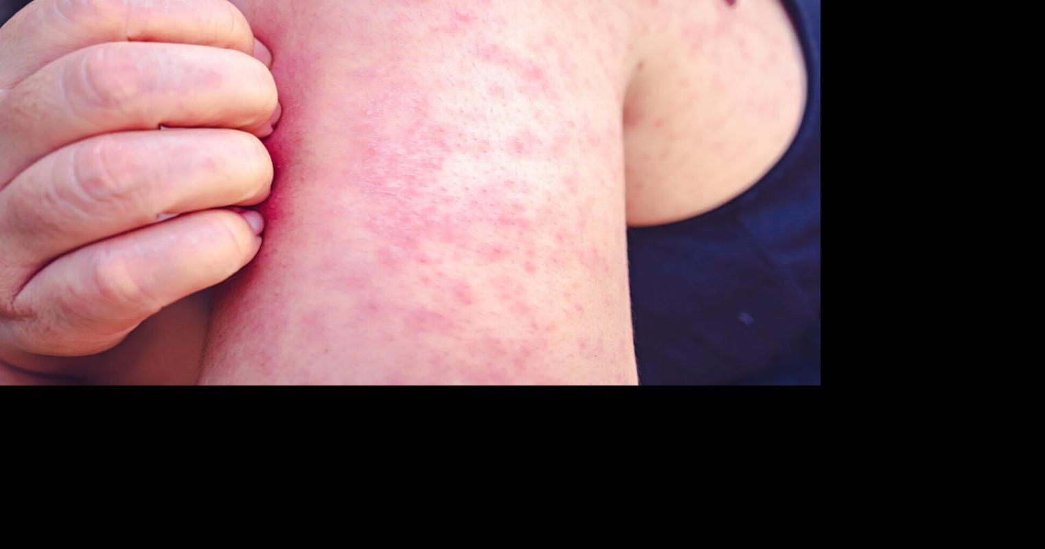 Montana health officials confirm Flathead County measles case
