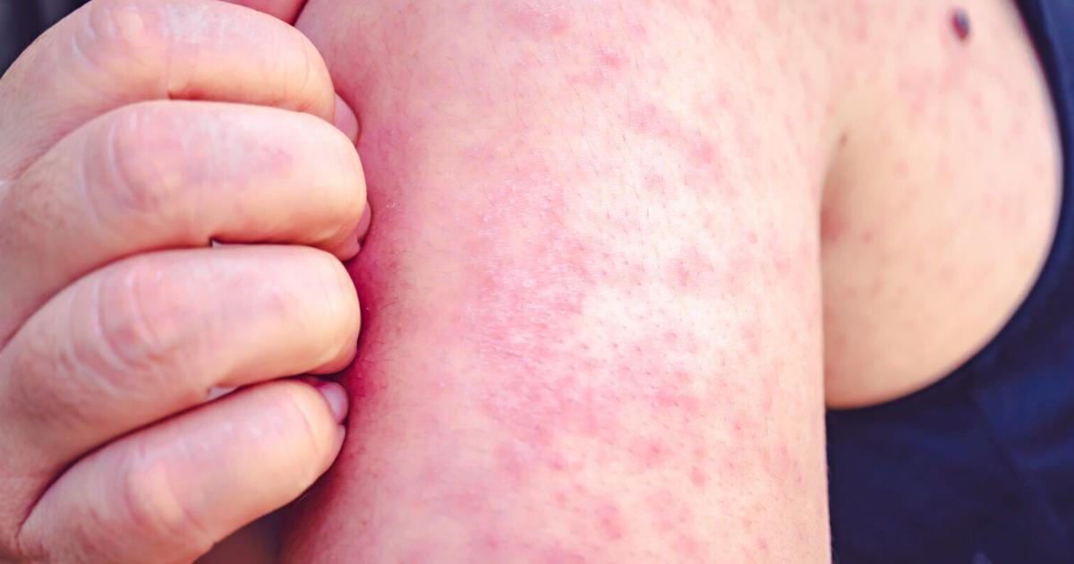 Montana health officials confirm Flathead County measles case