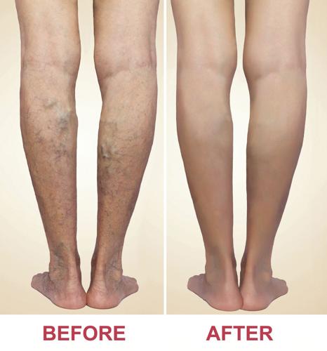 The Vein Clinic and Vascular Interventional Specialists - UNHEALTHY VEINS  AFFECY QUALITY OF LIFE Ever wonder why varicose vein patients are  recommended to wear compression hose/stockings? Ultimately, compression hose/stockings  are designed to