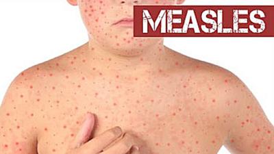 measles2.jpg