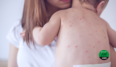 measles ncpa - 1
