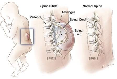 spina bifida life expectancy 1950