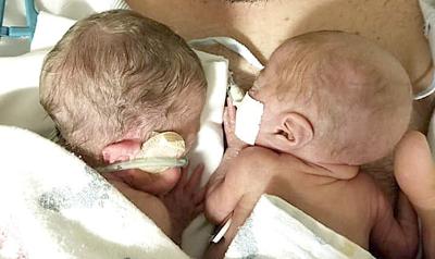Andrew and Catie Scott's twin daughters, Madi and Parker, who were born premature and weighed just over 1 pound each.