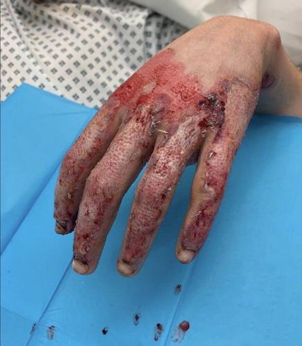 Horrific pictures show apprentice’s injuries after becoming ‘human fireball’