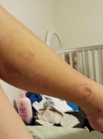 Festus woman hospitalized for copperhead bite