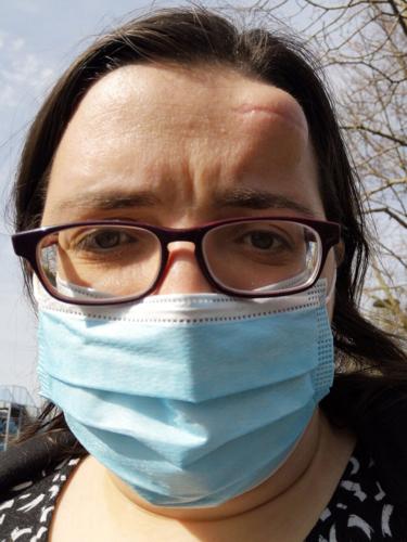 “I thought my lump was a cyst, but it was actually deadly cancer eating my skull”
